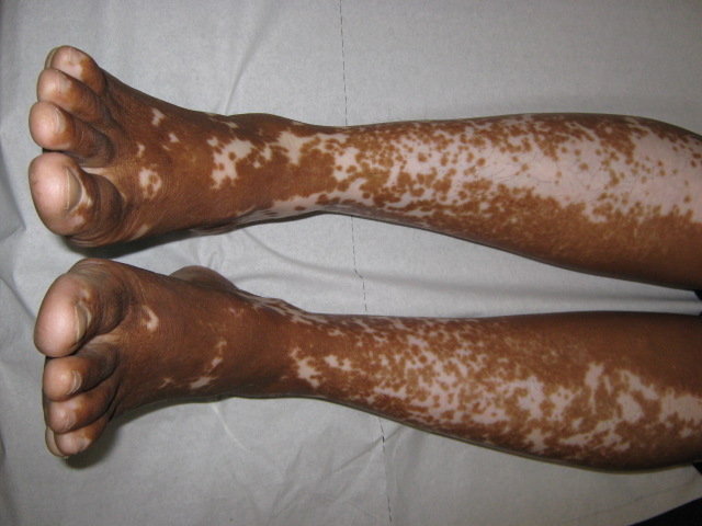 vitiligo