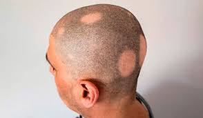alopecia of a men