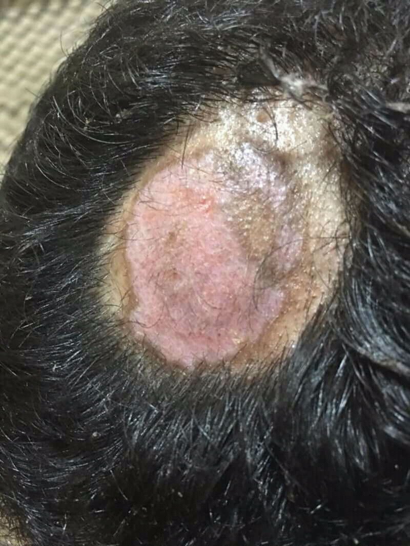 discoid lupus on the scalp