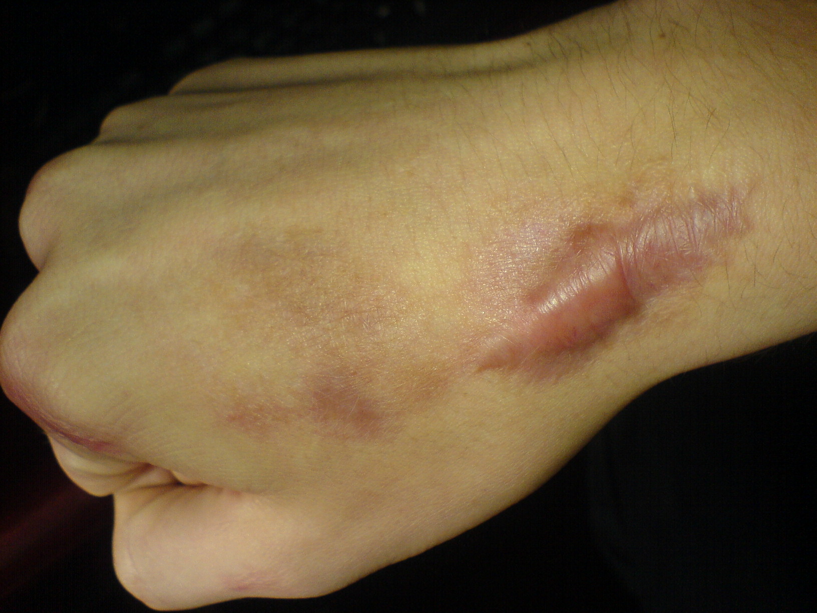 keloid on the hand