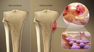 Osteomyelitis and normal bone