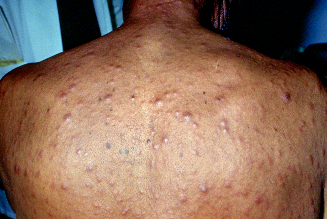 syphilis symptom on the back