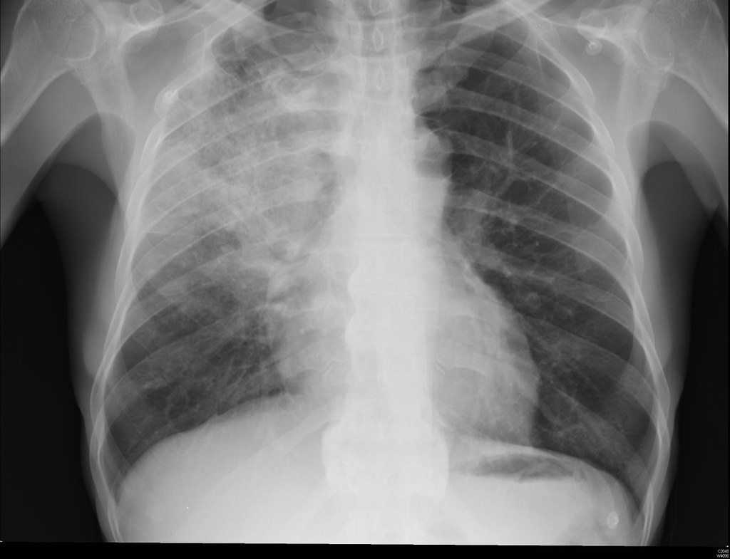 xray of lungs with pneumonia