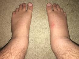 cellulitis