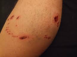 animal bite