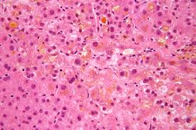 hepatitis under the microscope