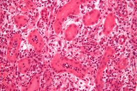 Pyelonephritis