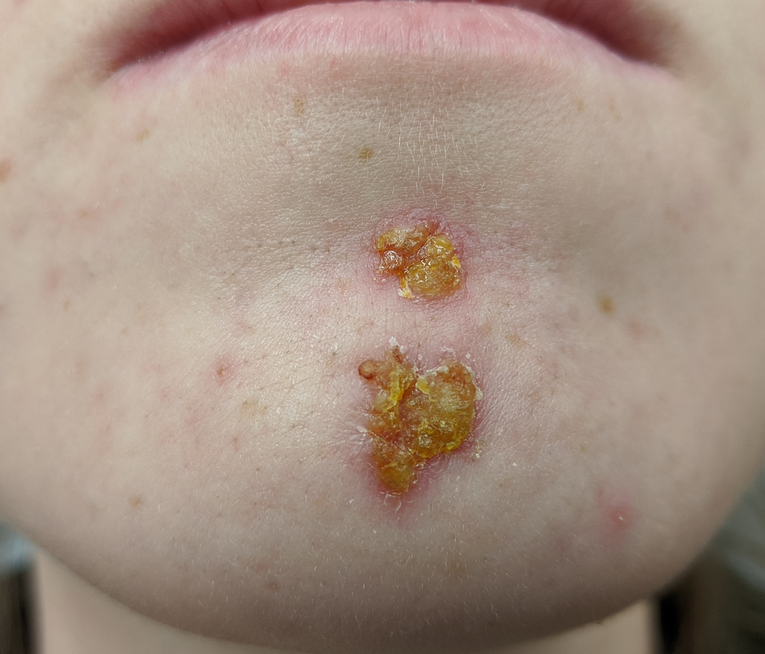 impetigo on the chin