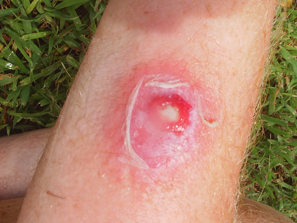 Skin infection on the arm