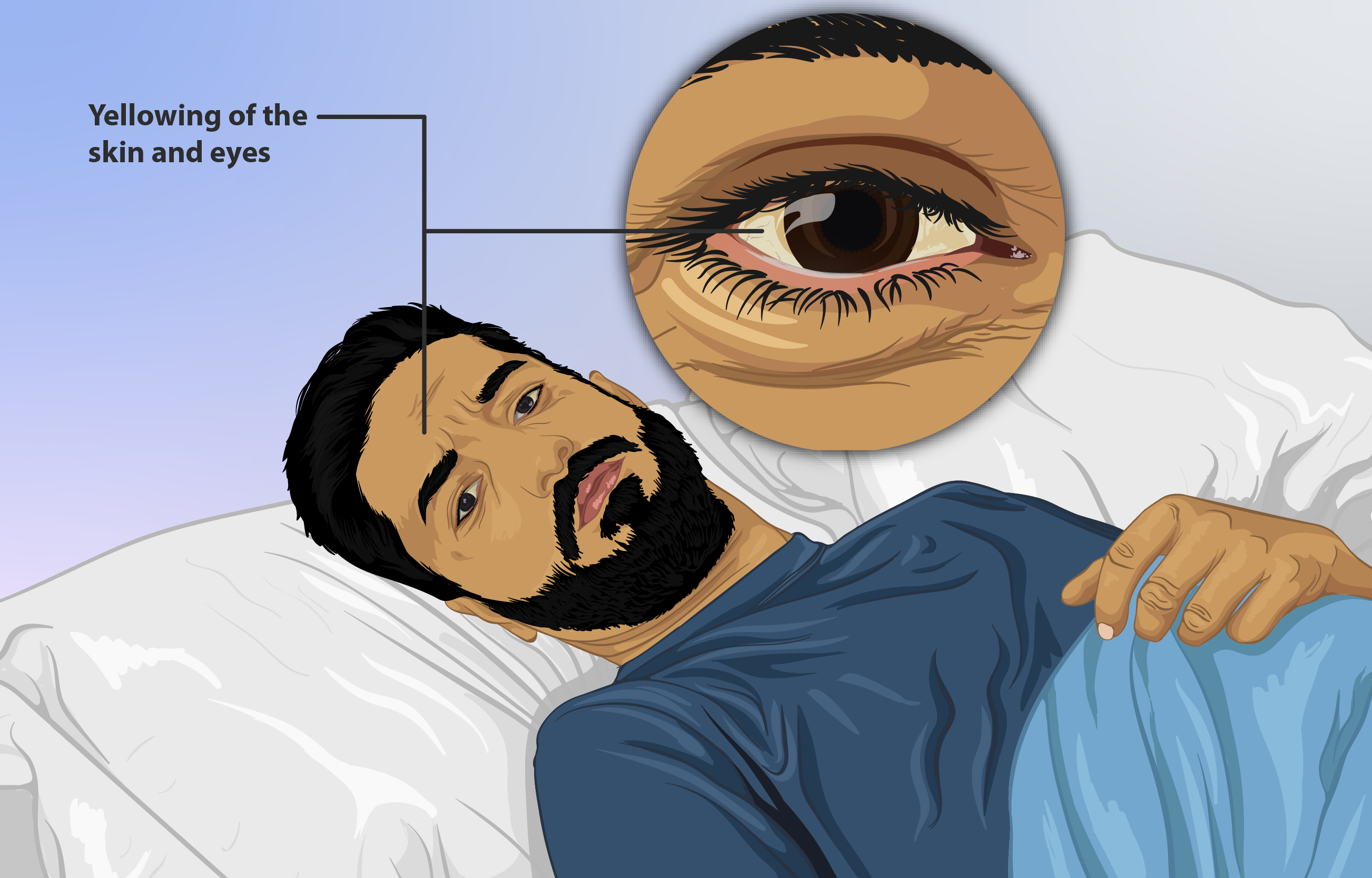 person with jaundice