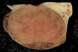 oophorectomy of uterus