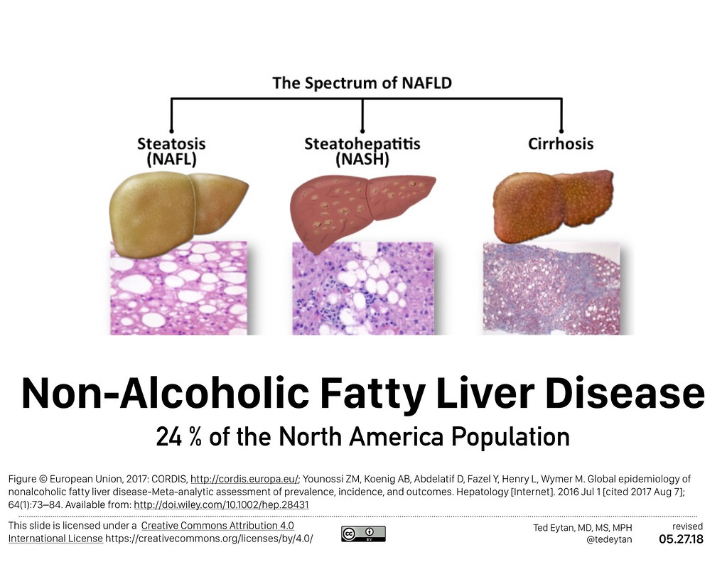 Nonalcoholic fatty liver disease