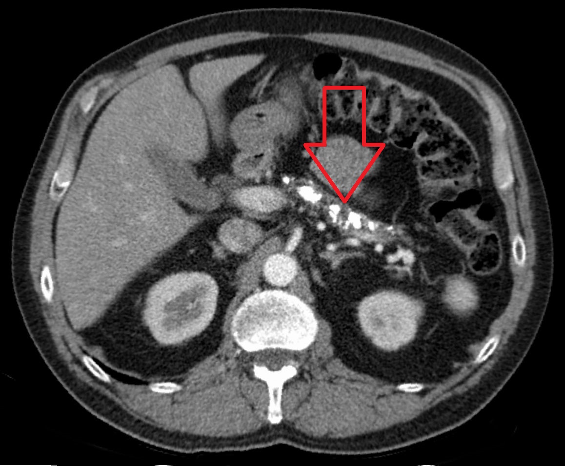 pancreatitis xray