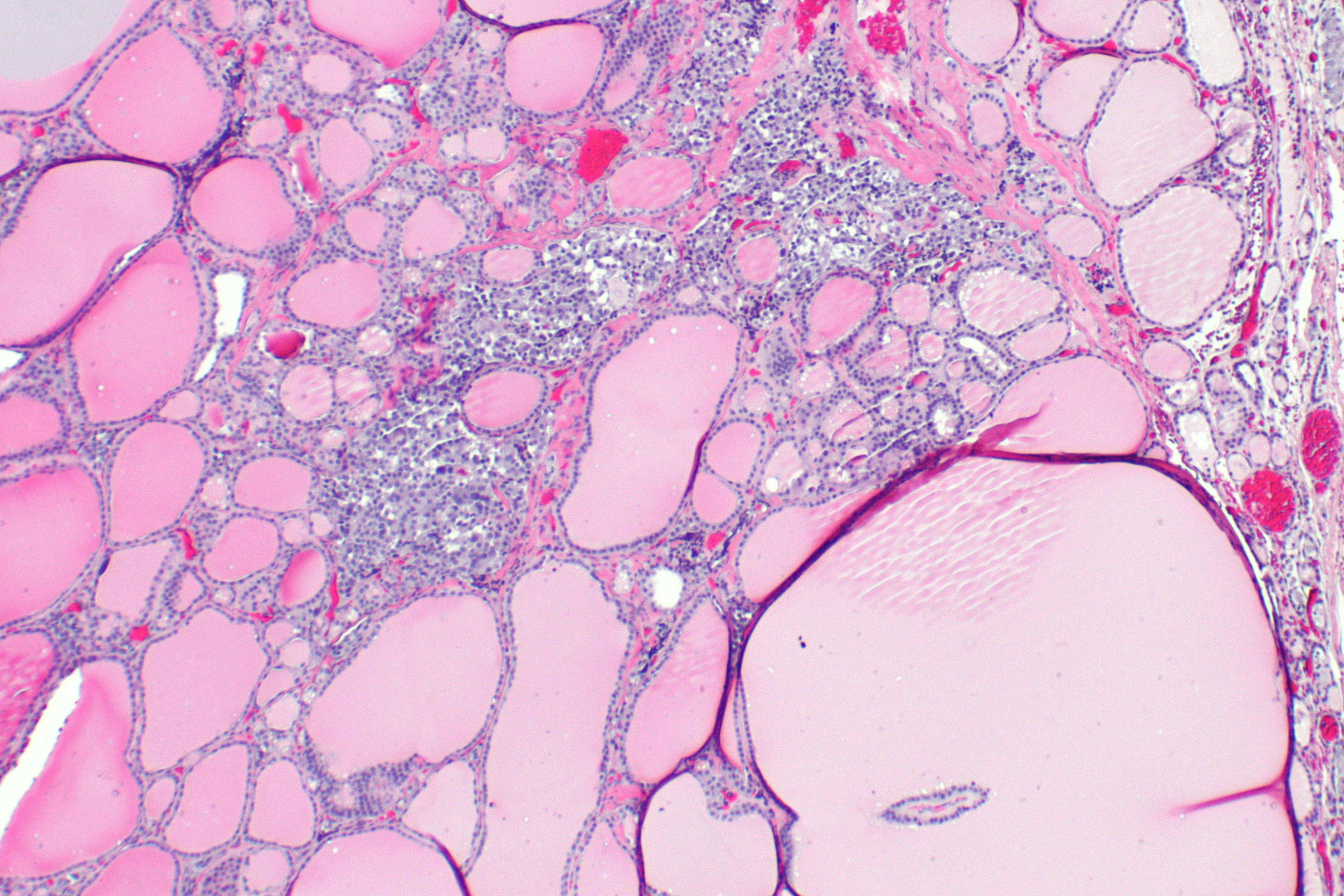 thyroid c cell