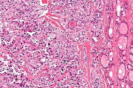 thyroid carcinoma