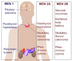 Multiple Endocrine Neoplasia Syndrome Type 2
