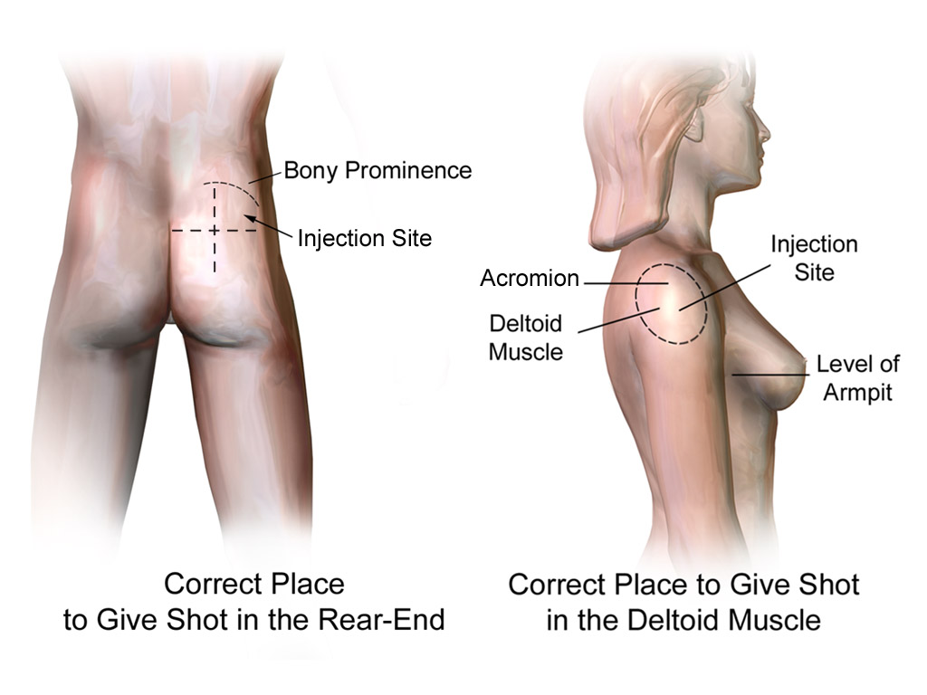 intramuscular injection sites in the body 