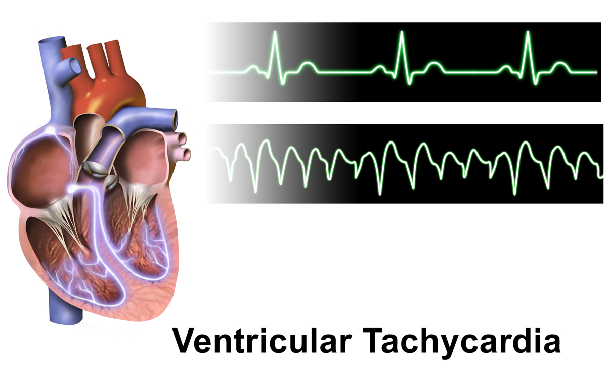 Tachycardia of the heart scan