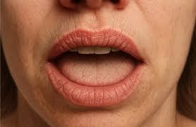 dry mouth
