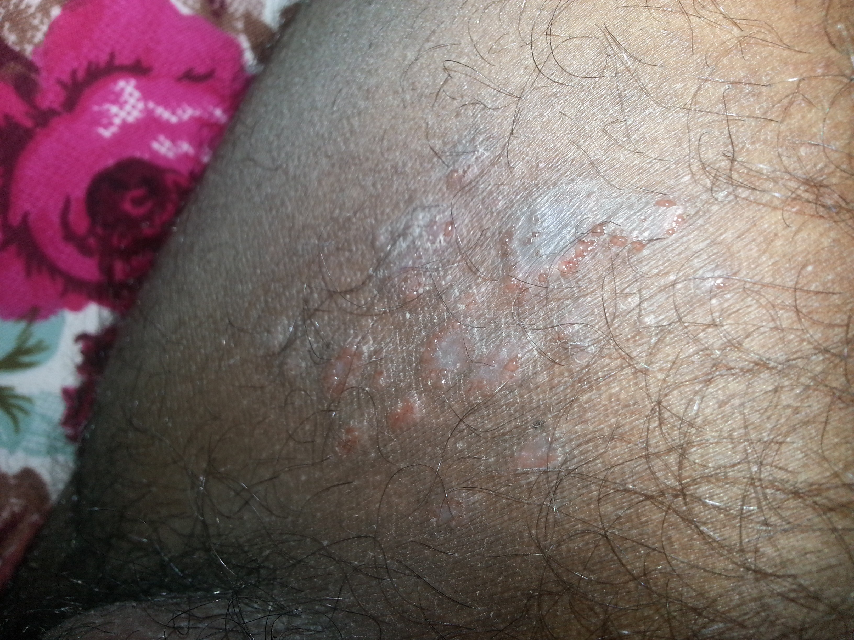 fungal infection of the skin