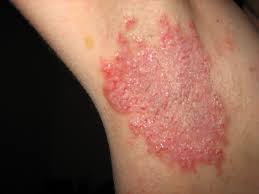 yeast based skin infection