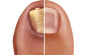 nail infection