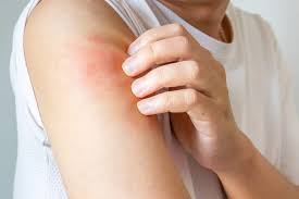 scratching itchy arm