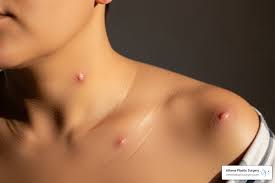 raised itchy welts on the shoulder