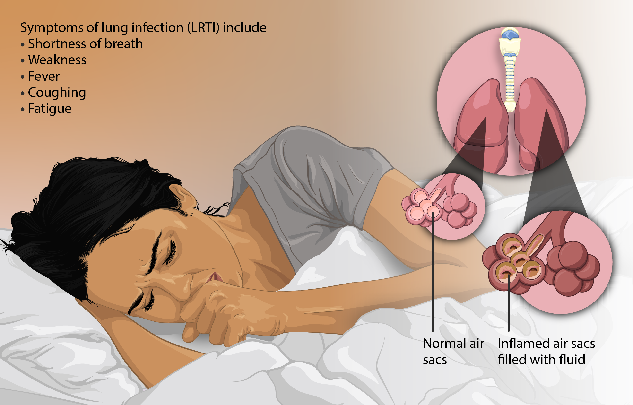 Respiratory tract infection