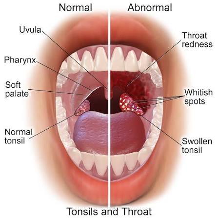 Tonsillitis