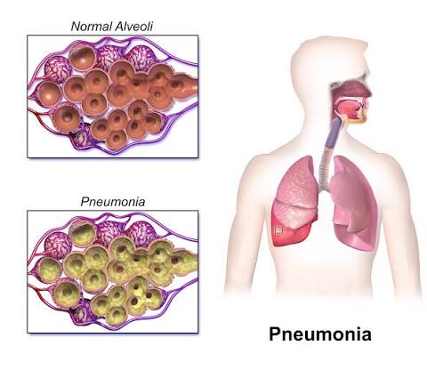 Pneumonia in the lungs how it looks like