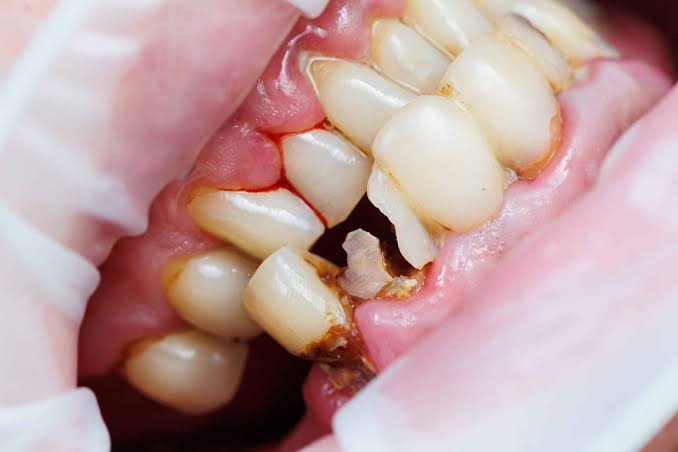 tooth decay