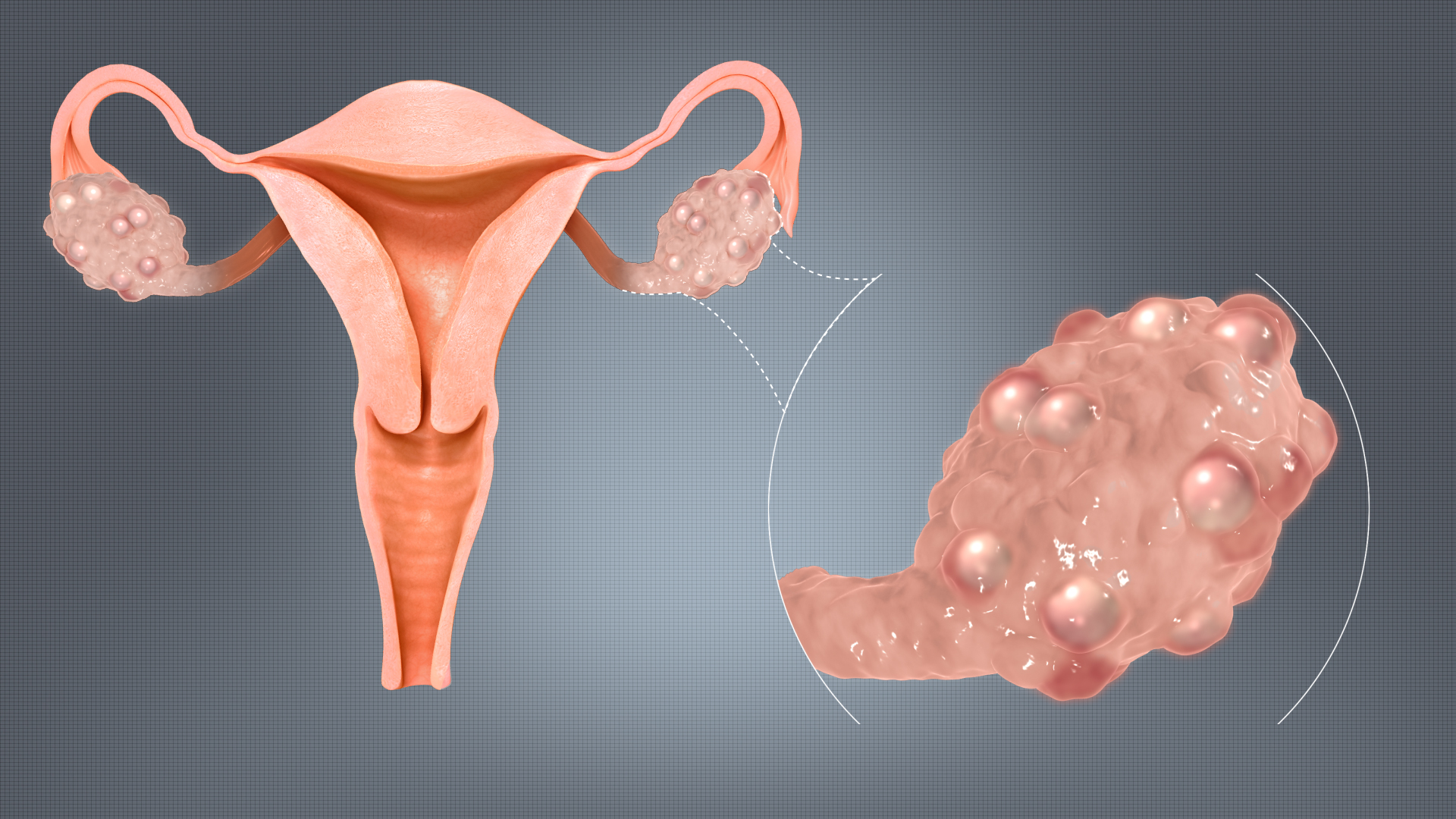 PCOS in woman