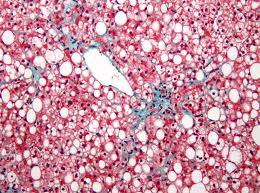 NAFLD under the microscope