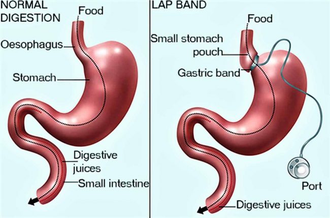 weight loss surgery