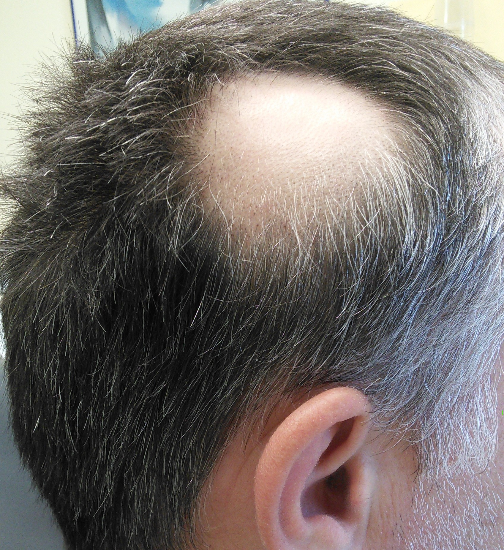 Androgenetic alopecia