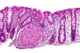 Crohn's-Disease Microscopic view