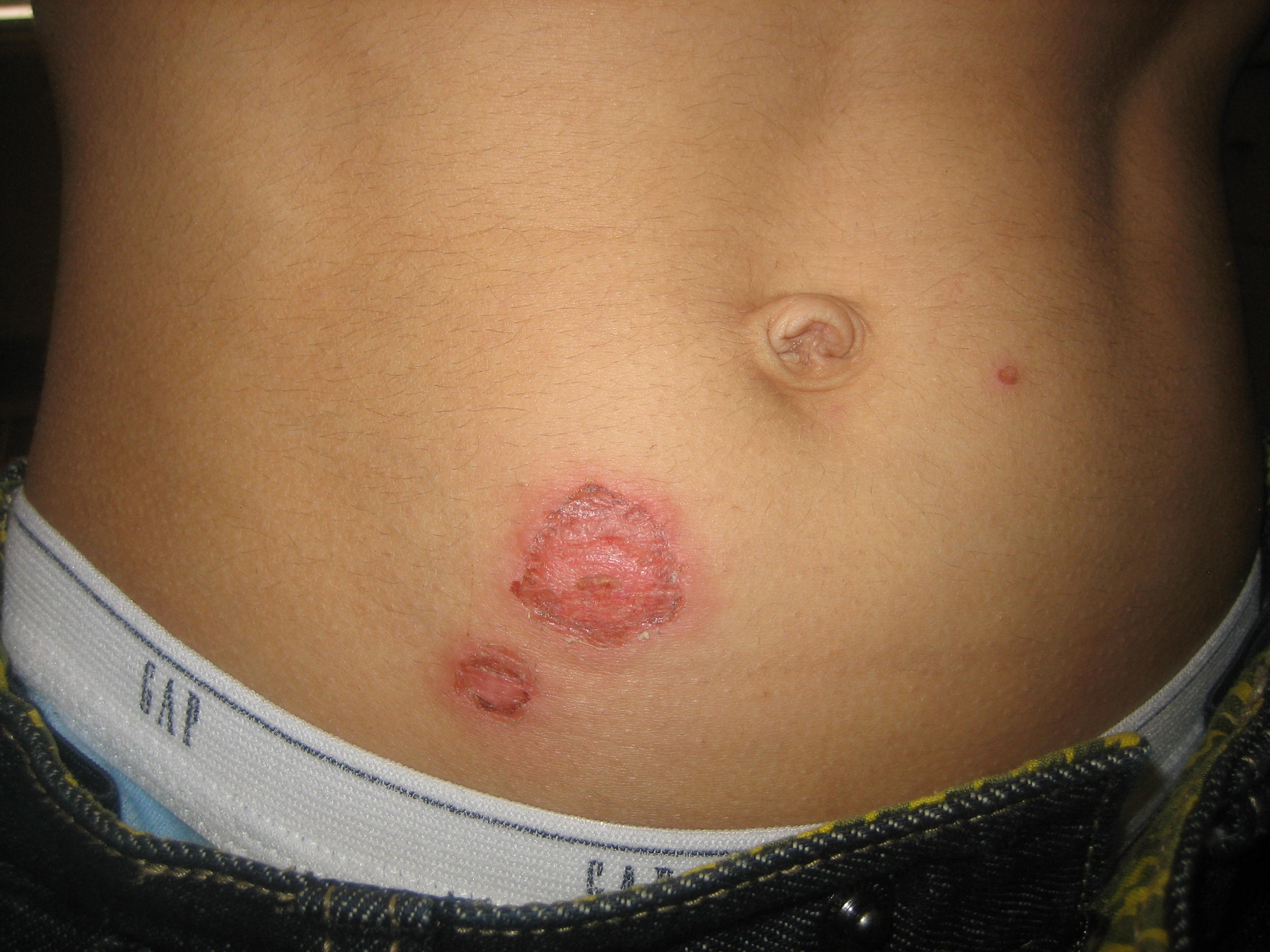 Impetigo