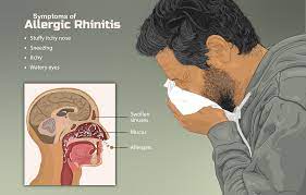 Allergic-rhinitis