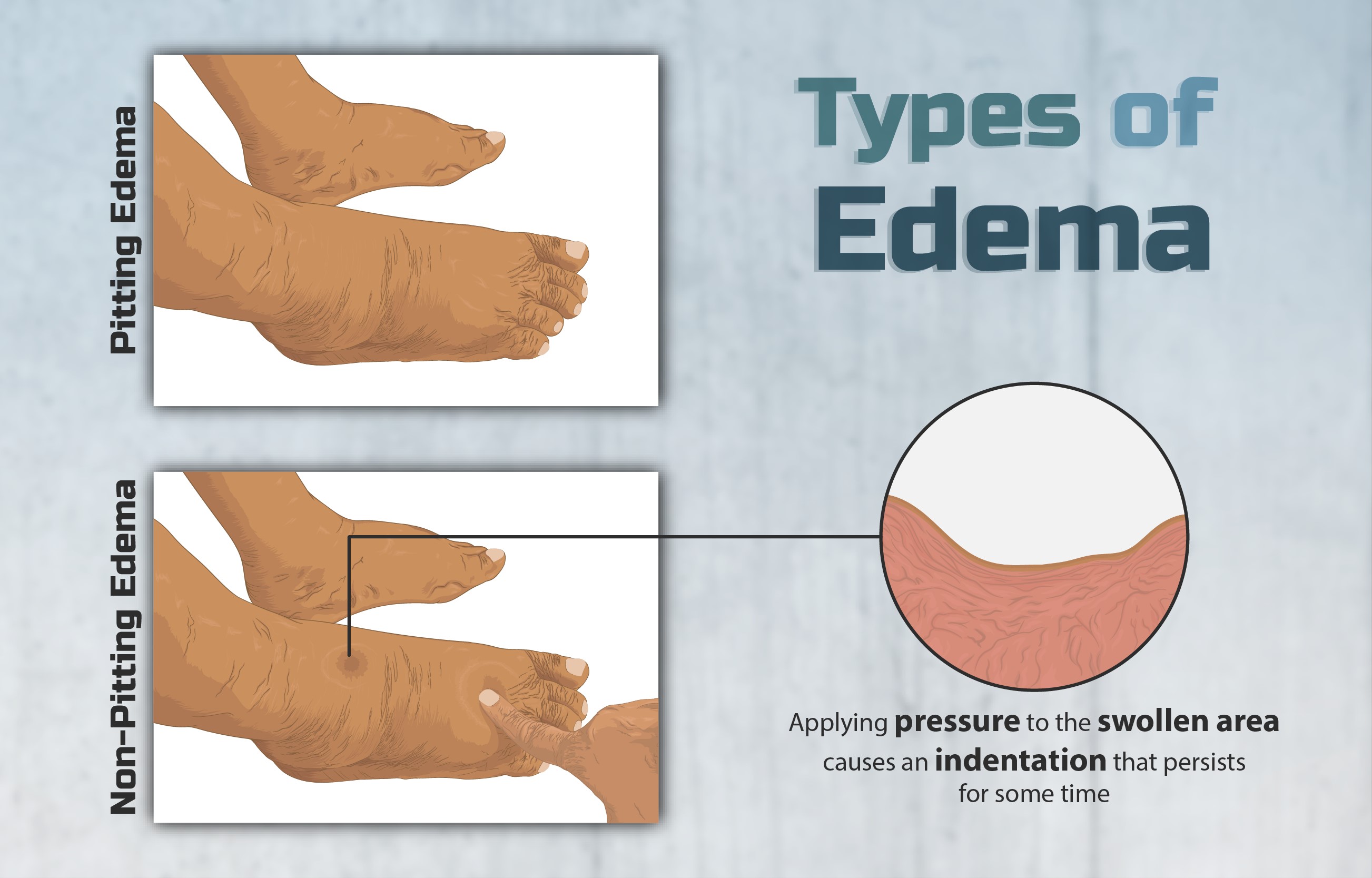 Edema