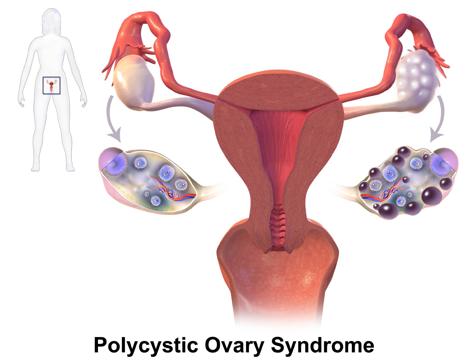 PCOS