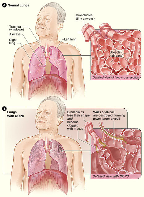 COPD