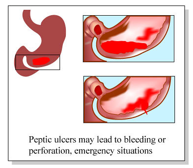 Gastric Ulcer