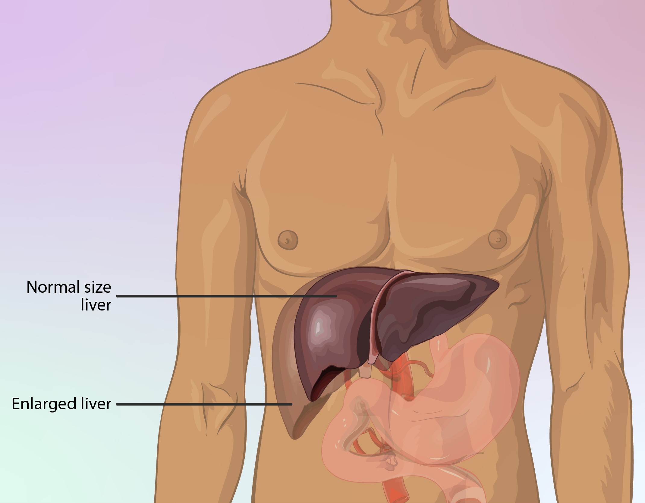 Enlarged Liver
