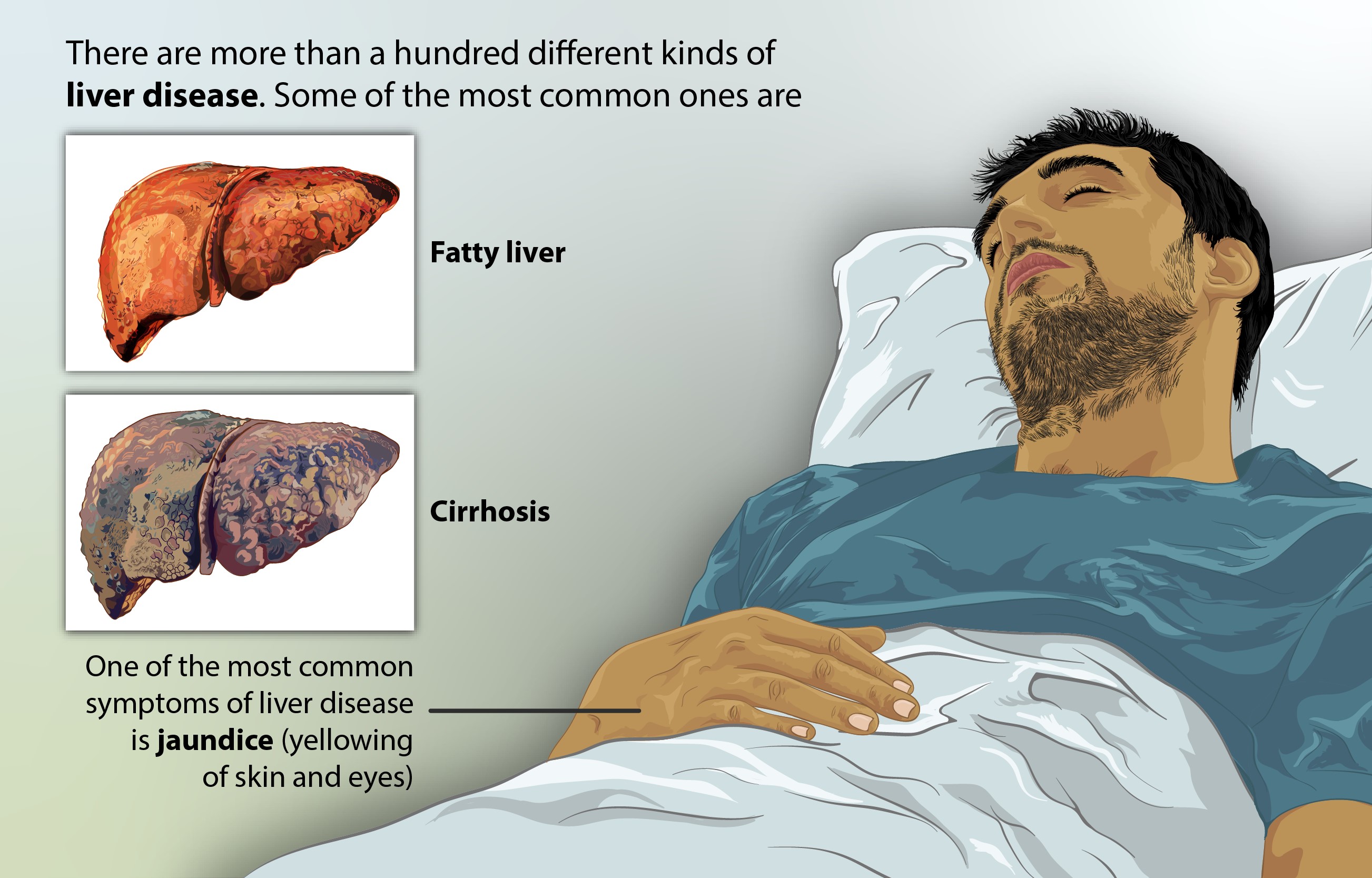 Liver Cirrhosis