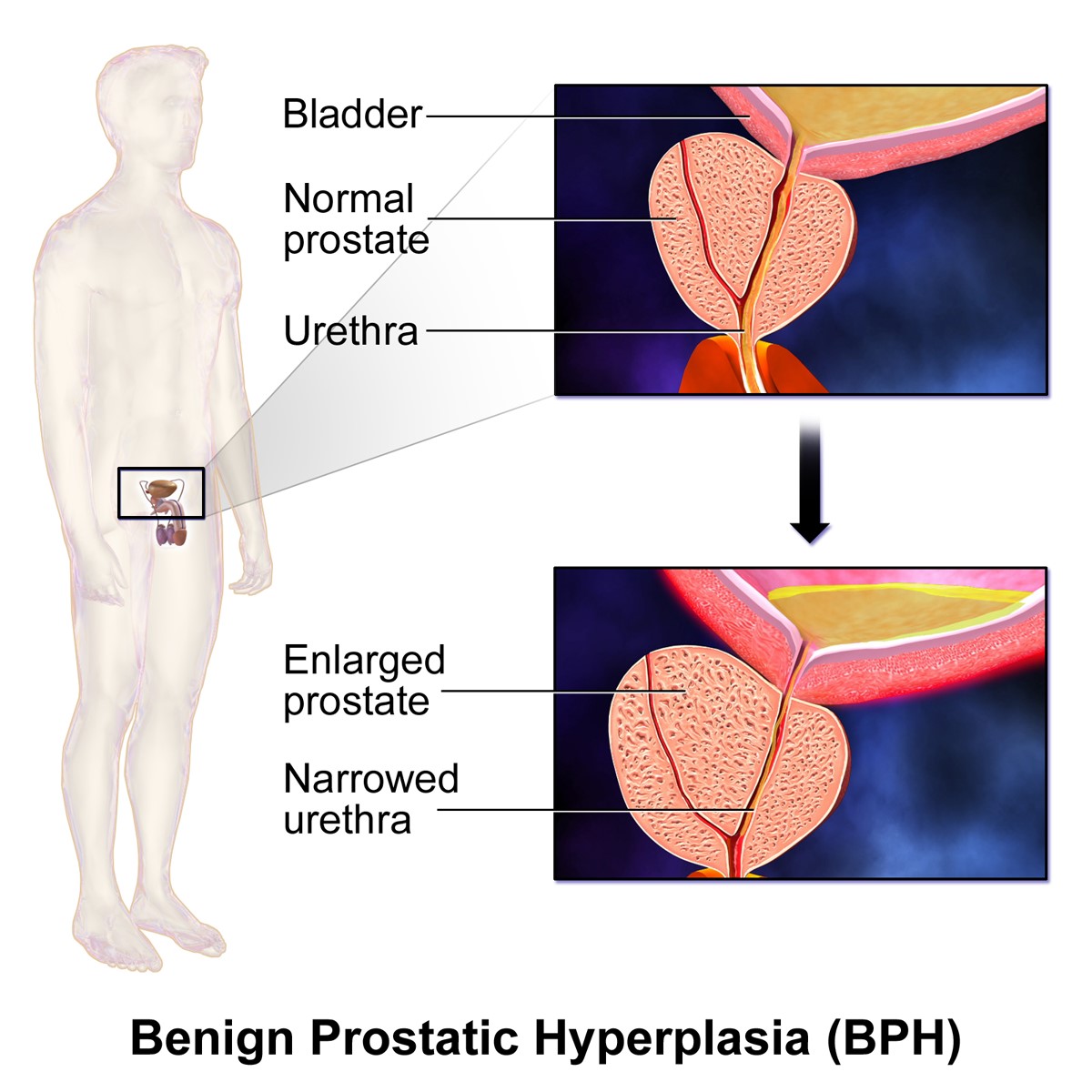 Benign Prostatic Hyperplasia