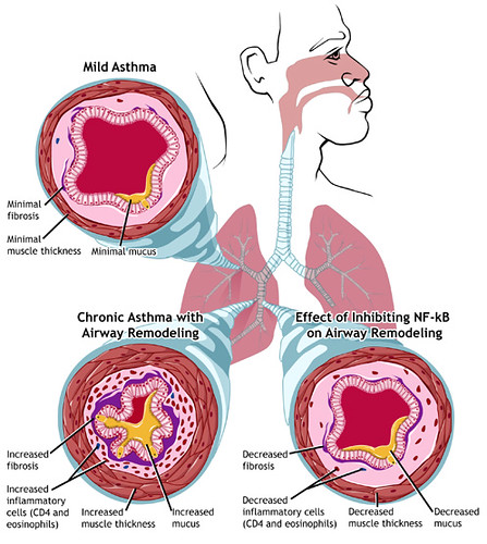 Asthma