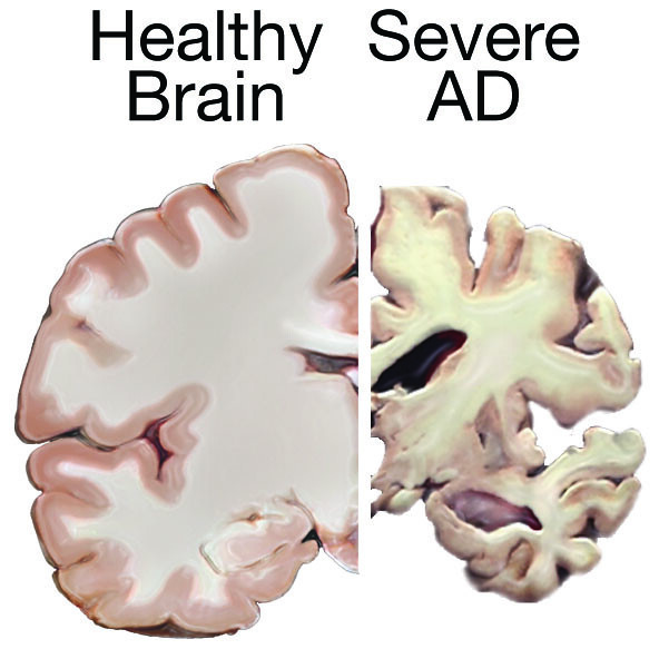 Alzheimer's brain