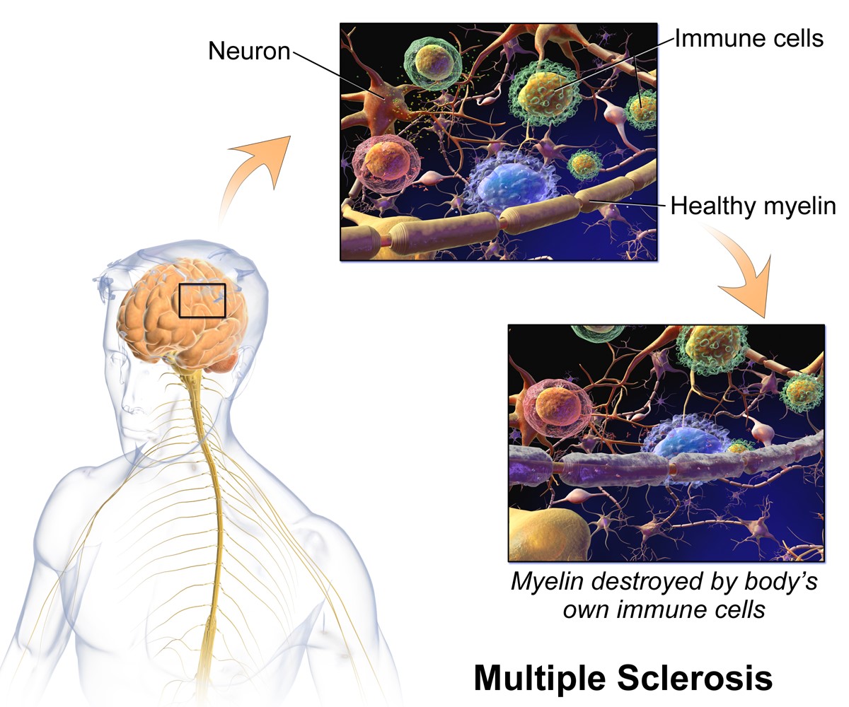 Multiple-Sclerosis