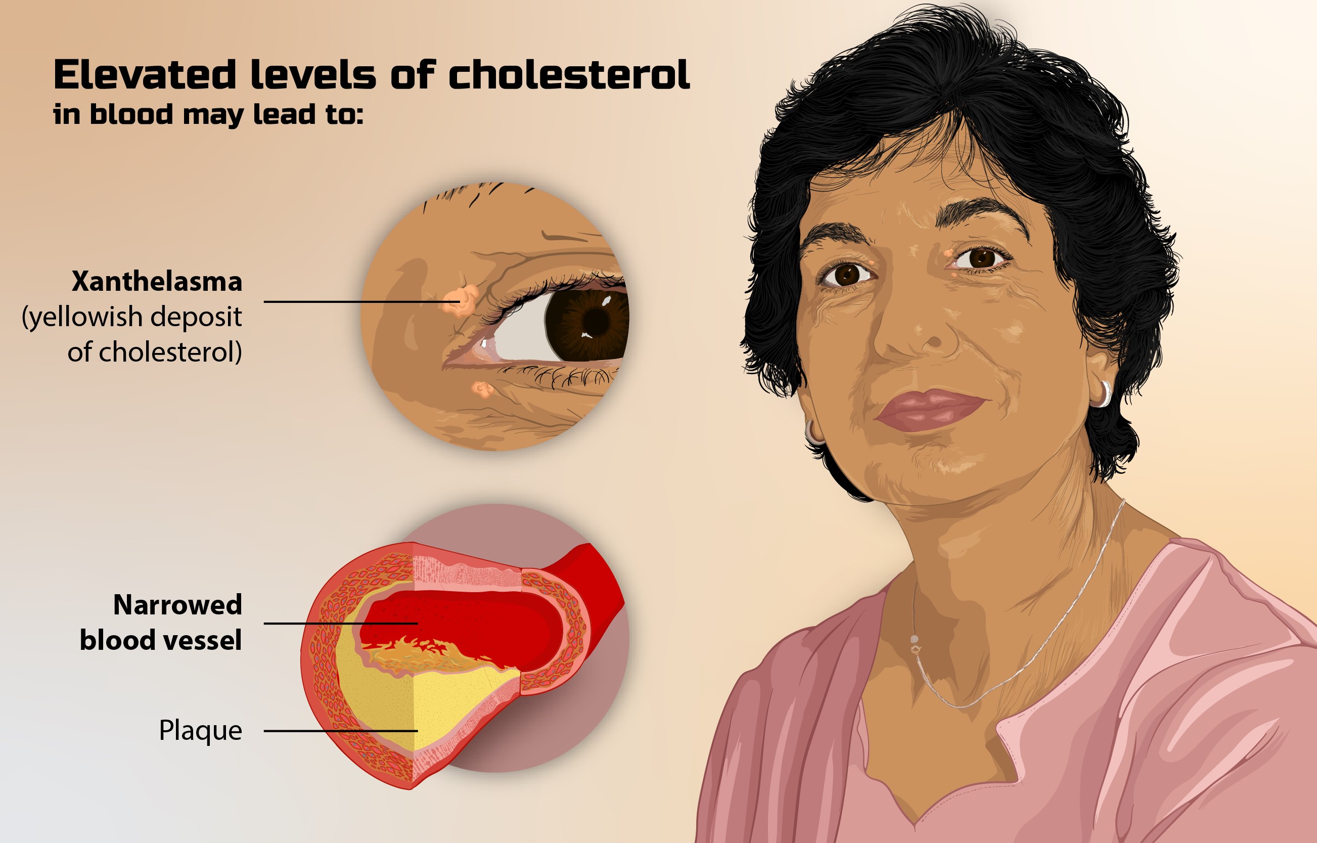 Person with High Cholesterol